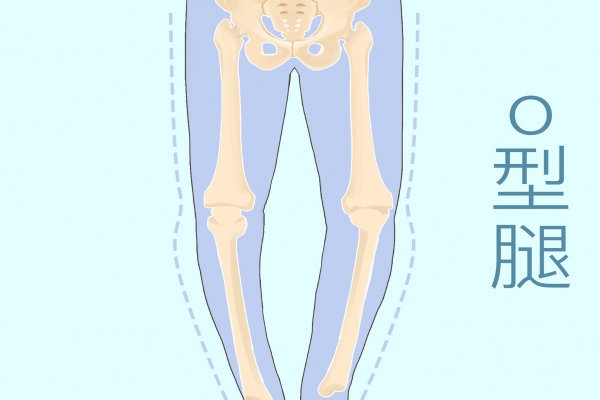O形腿矫正方法_m坐姿可以改善腿型_深蹲单腿站立改善O型腿