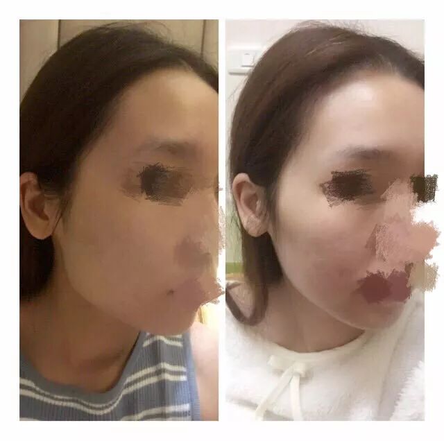 pg电子麻将胡了 医美 | 我的削骨回忆录