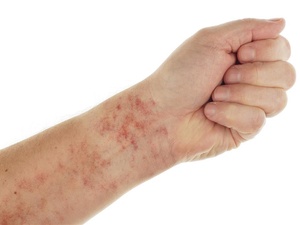 手臂上小红点不痛不痒怎么回事