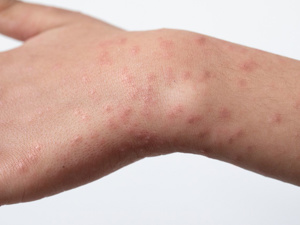 手臂上小红点不痛不痒怎么回事