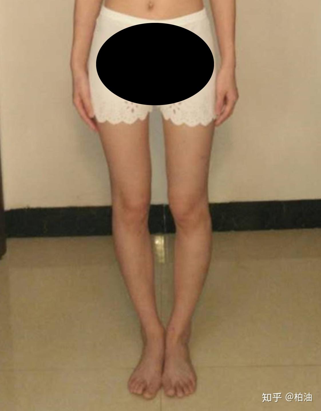 腿向后踢屁股有什坏处_X型腿O型腿区别_腿型分析