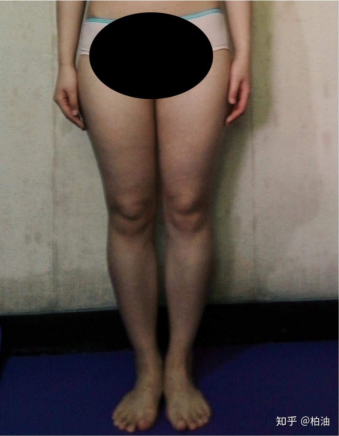 腿向后踢屁股有什坏处_腿型分析_X型腿O型腿区别