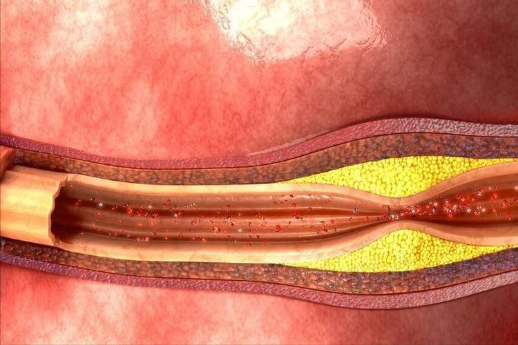 小腿酸胀深静脉血栓_小腿萎缩恢复锻炼方法_走路防血栓
